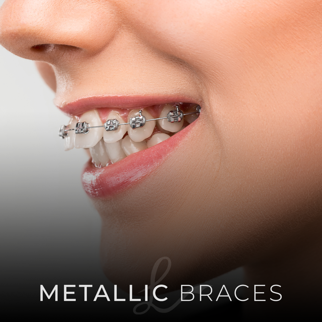 metallic Braces The Different Types of Orthodontic BRACES: Which Type is Right for You?