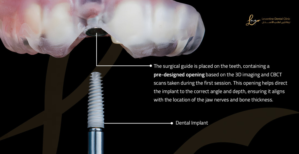 surgical guide Painless Dental Implants in Minutes! Using Surgical Guide Technology (No Scalpel or Stitches)