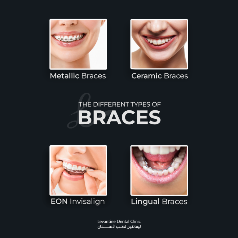 The Different Types of Orthodontic BRACES: Which Type is Right for You?