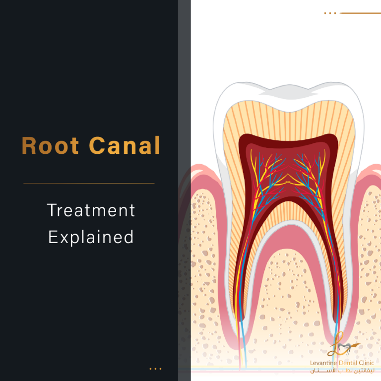 Root Canal Treatment Explained