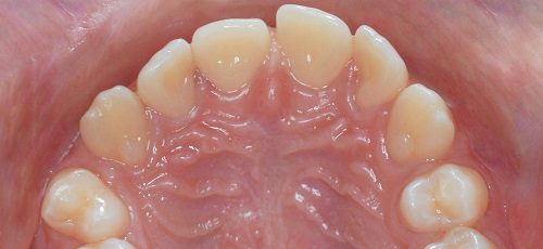 Case 45 - Before