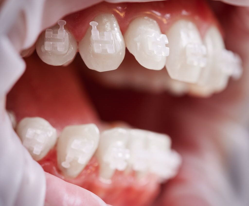 Ceramic Braces in Dubai