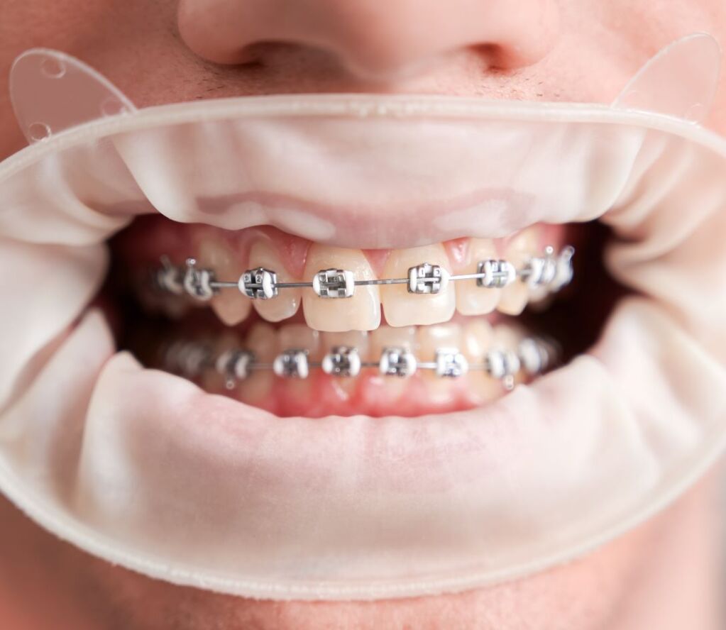 Metal Braces