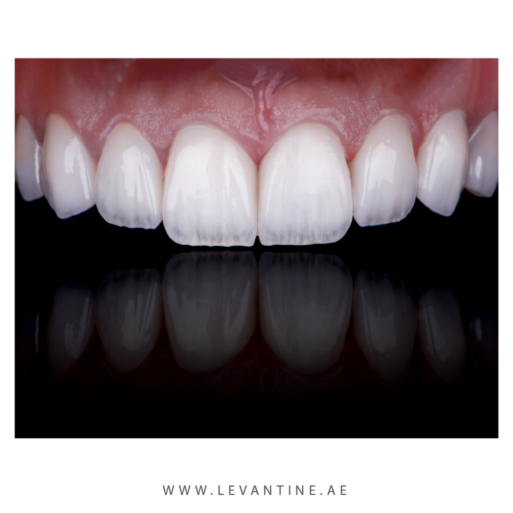 composite veneers Dental Veneers