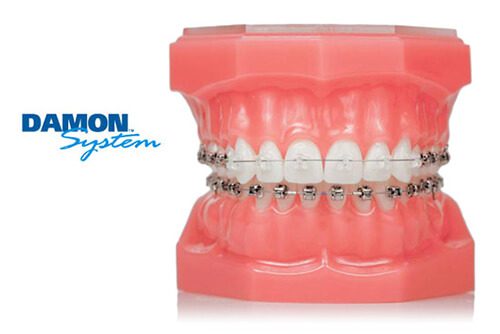 Damon Braces System