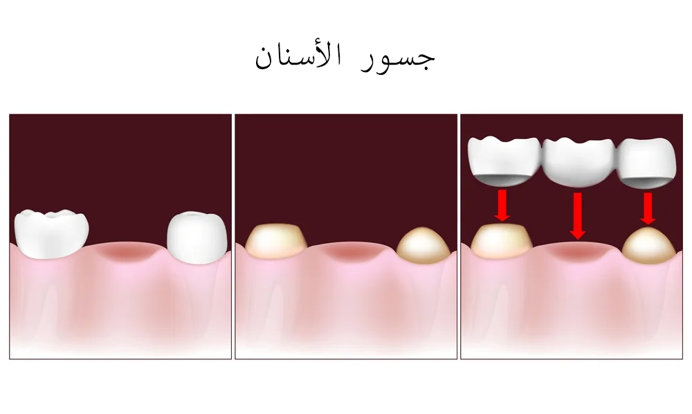 Dental Bridge Procedures in Dubai