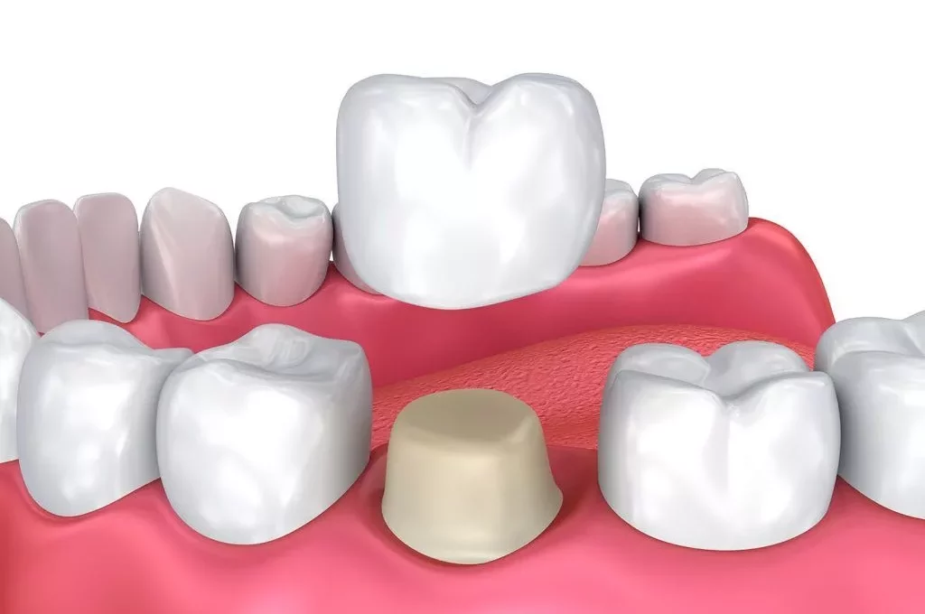 All Porcelain Crowns