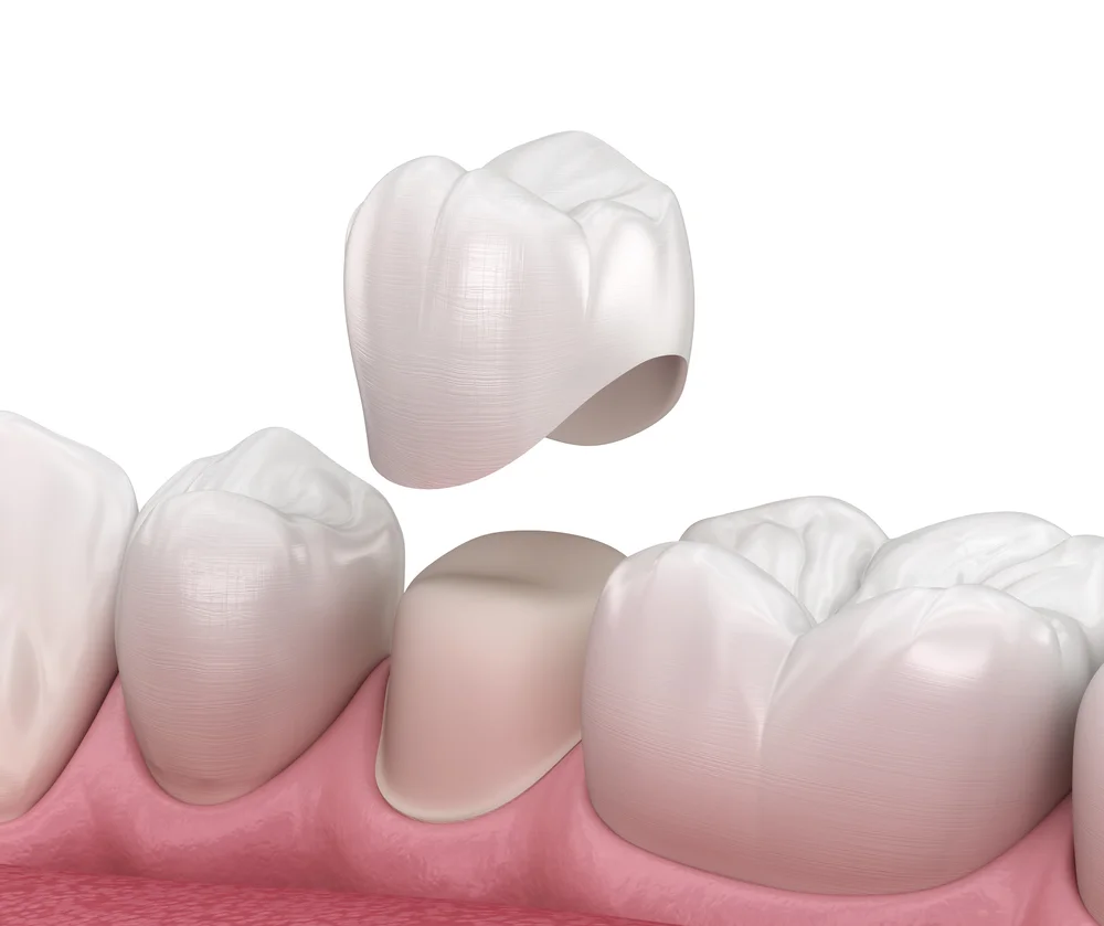 Best Clinic in Dubai for Dental Crowns