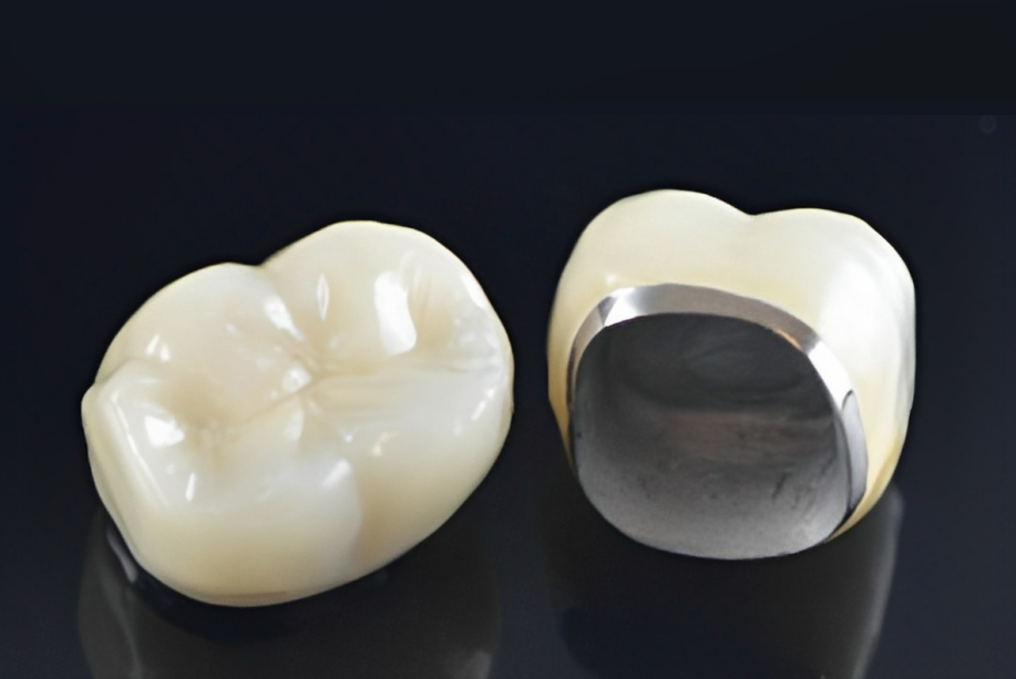 Porcelain Fused-to-Metal Crowns