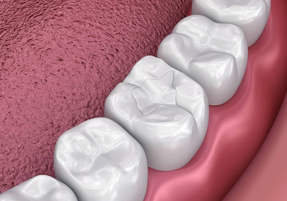 Composite Fillings