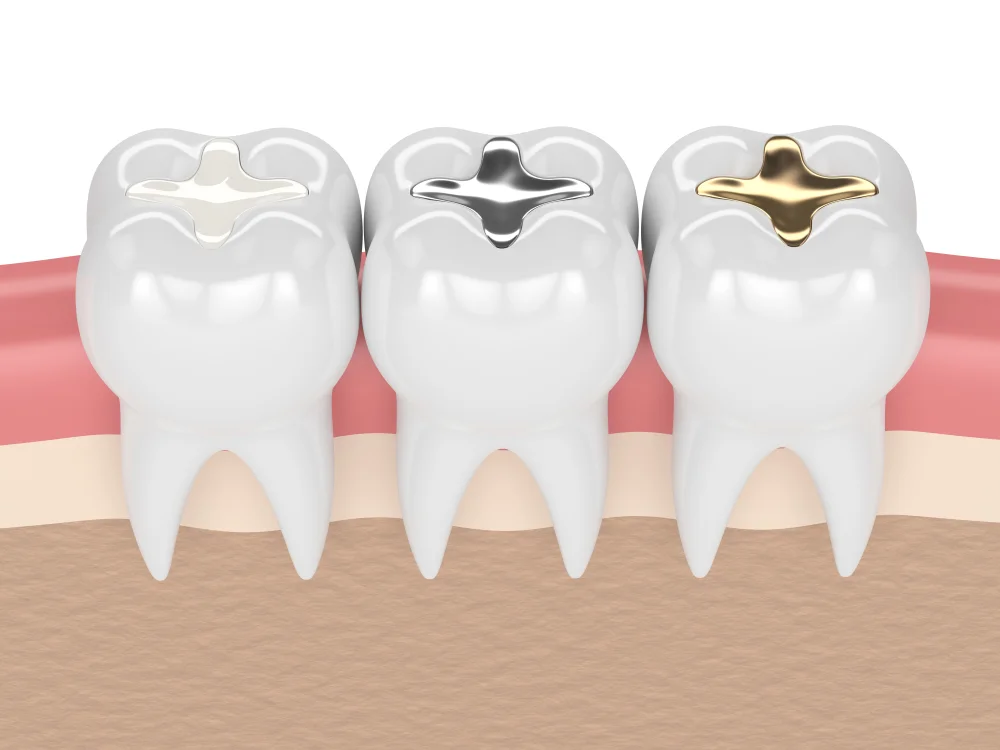 Dental Fillings in Dubai