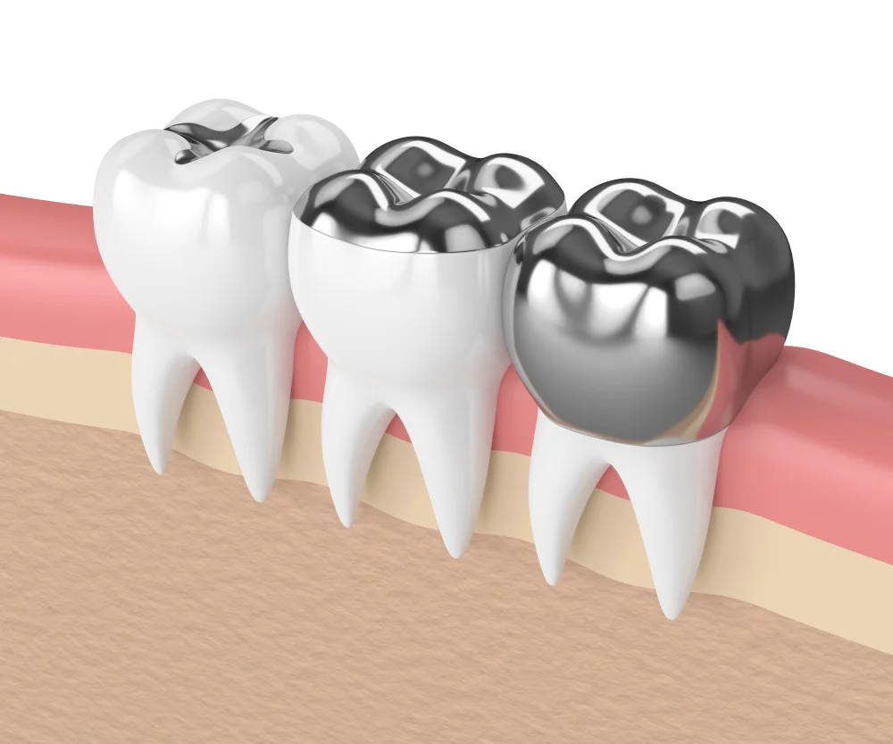 Silver Fillings