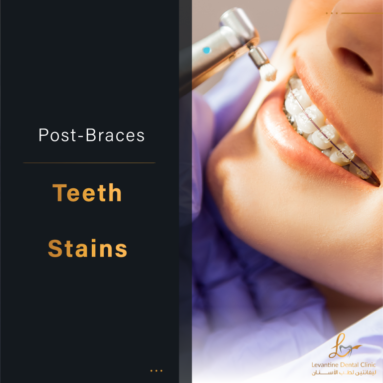 Post-Braces Teeth Stains