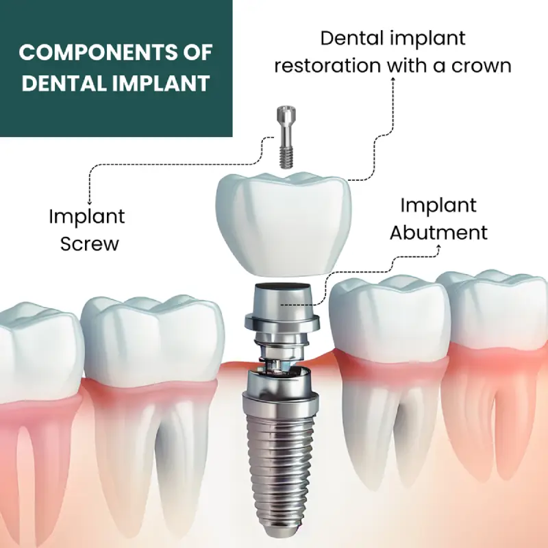 Dental Implant Benefits