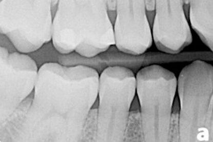 Bitewing X-Ray