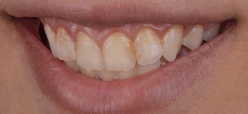 Case 17 - After
