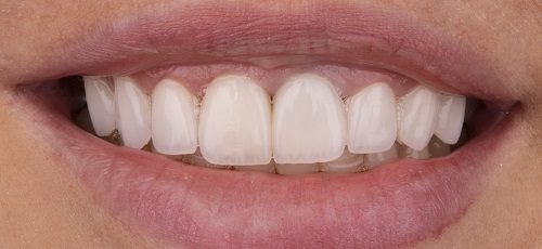 Case 11 - Before