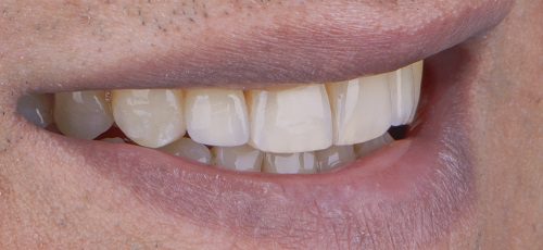 Case 20 - After