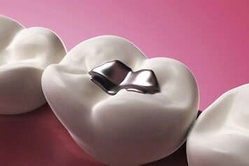 Amalgam Fillings