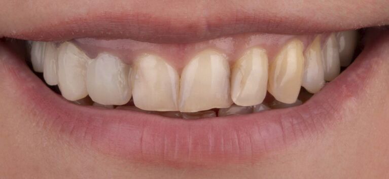 Hollywood smile makeover before