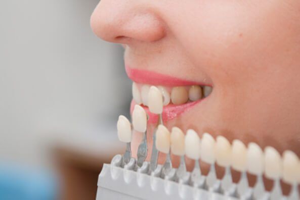 Dental Veneers