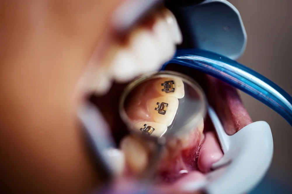 Advantages of Lingual Braces