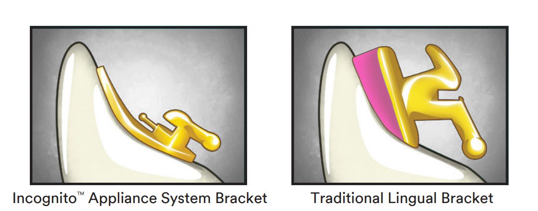 Incognito lingual braces