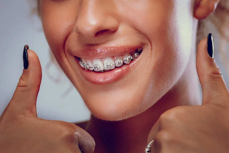 Traditional Braces