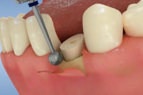Crown Lengthening