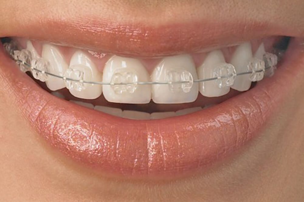 Crystal Braces