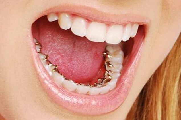 Lingual Braces