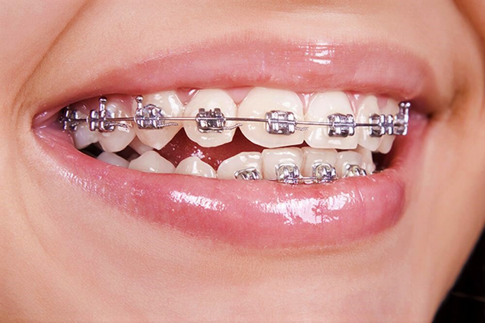 Metal/Traditional Braces