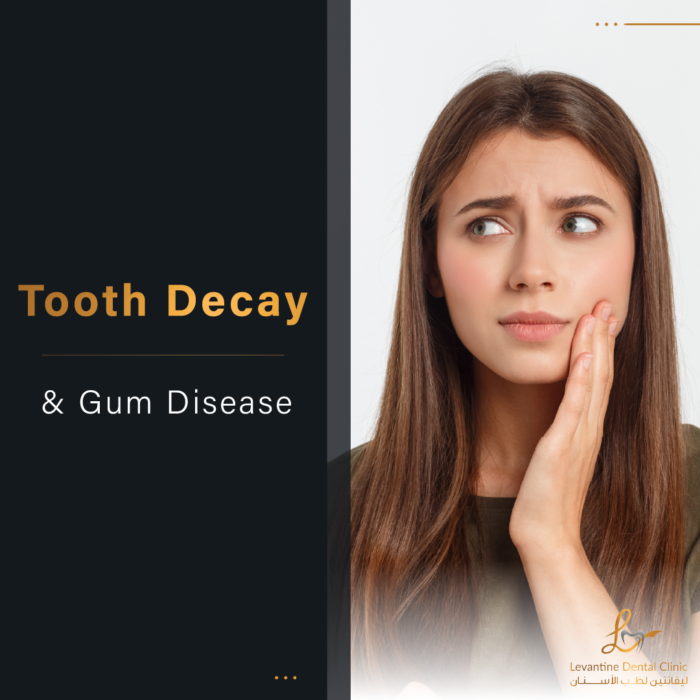 Tooth Decay