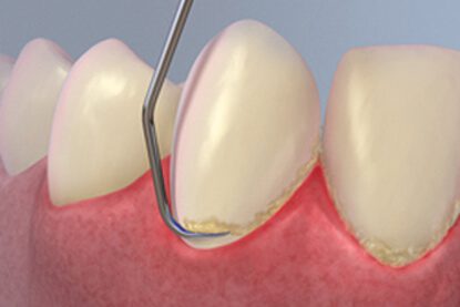 Dental Scaling