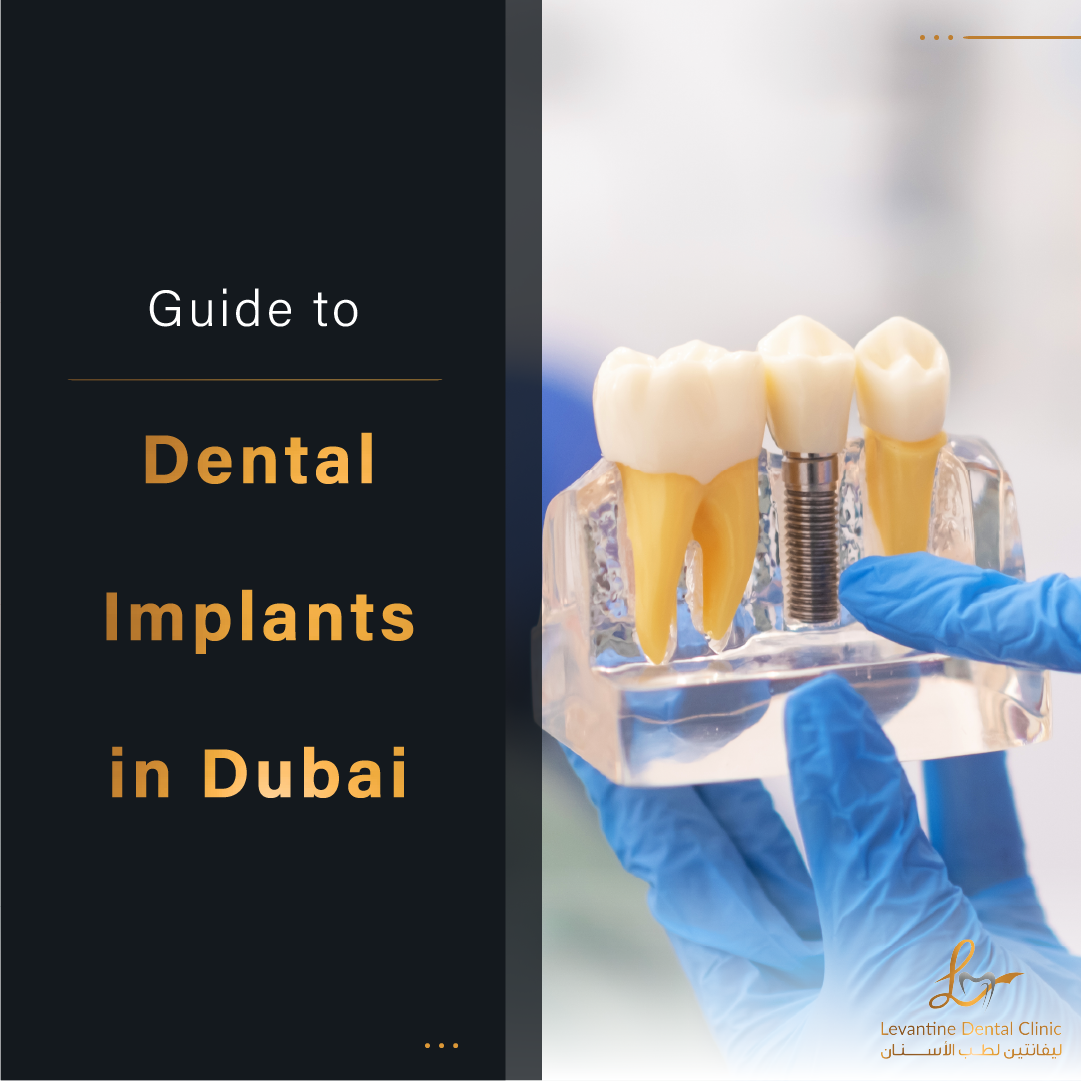 Best Dental Implants in Dubai