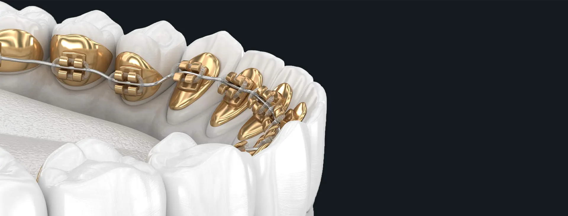 Hidden Braces