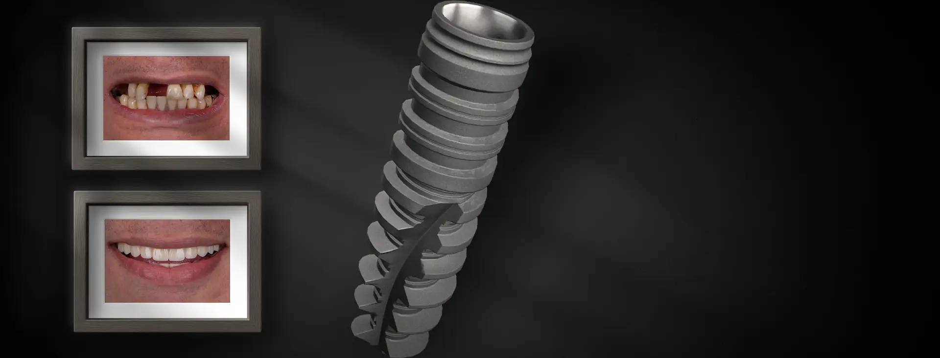 Same Day Implants