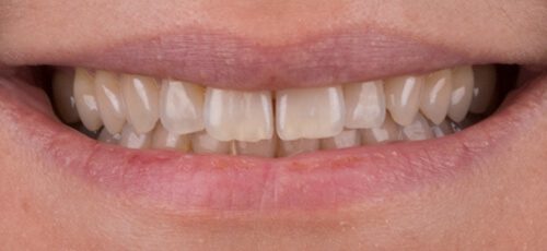 Veneers Case 1 - Before