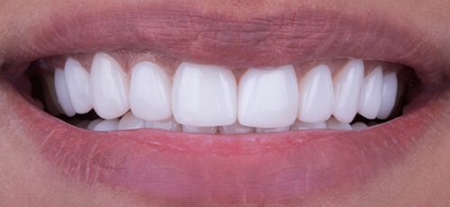 Veneers Case 3 - After