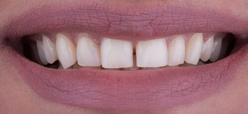 Veneers Case 3 - Before