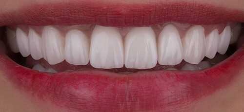 Veneers Case 2 - After