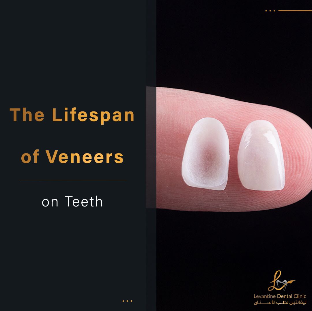 Uncovering The Lifespan Of Veneers On Teeth How Long Do They Last?