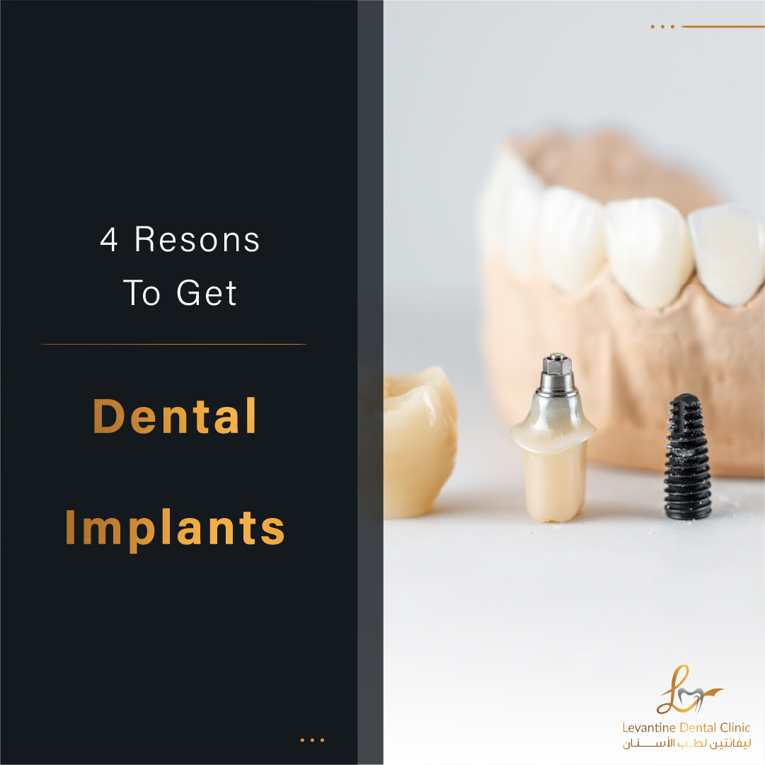 4 Reasons To Get Dental Implants At Levantine Dental Clinic